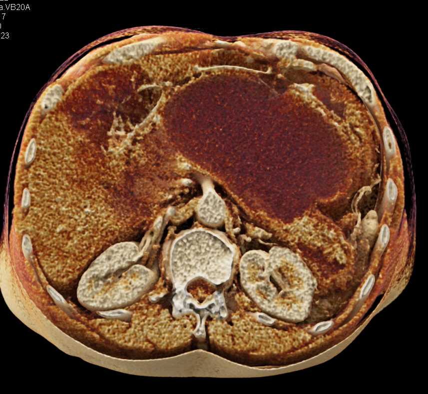 Large Pseudocyst Following Pancreatitis - CTisus CT Scan