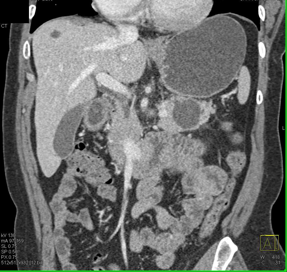 MCN (Mucinous Cystic Neoplasm) Tail of Pancreas - CTisus CT Scan