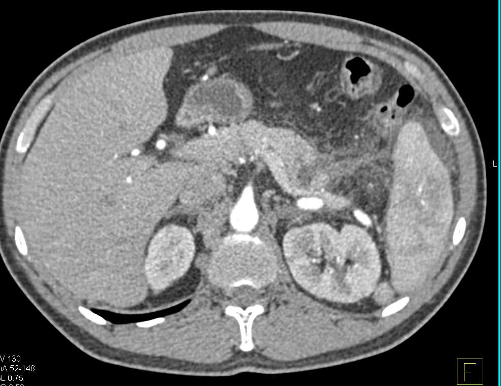 Pancreatitis Involves the Tail of the Pancreas - CTisus CT Scan