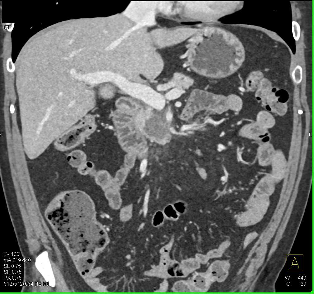 Intraductal Papillary Mucinous Neoplasm (IPMN) with High Grade Dysplasia - CTisus CT Scan