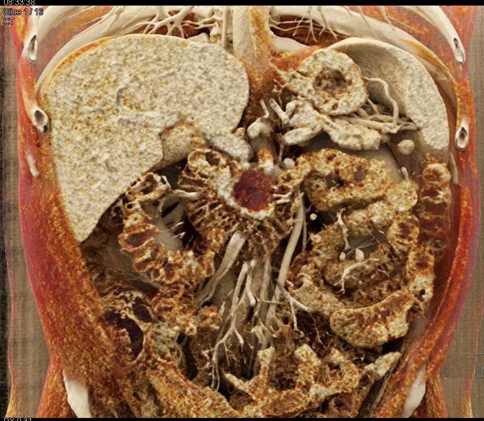 Intraductal Papillary Mucinous Neoplasm (IPMN) with High Grade Dysplasia - CTisus CT Scan