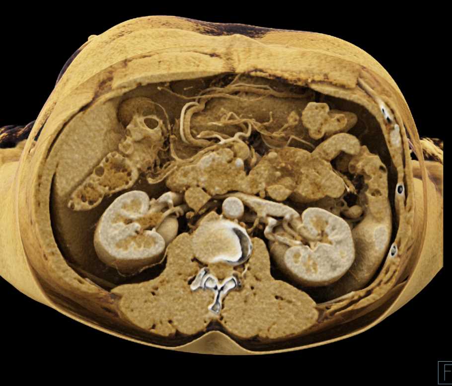 Adenocarcinoma Head of Pancreas with Cinematic Rendering - CTisus CT Scan