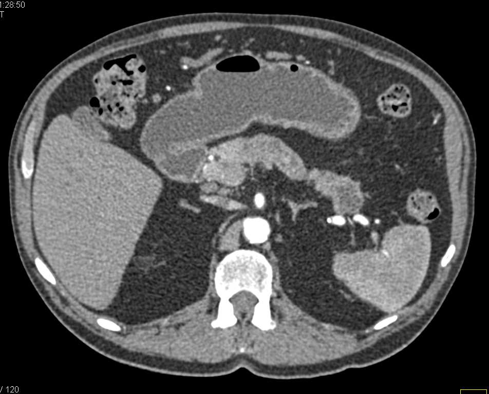 Intraductal Papillary Mucinous Neoplasm (IPMN) Pancreas - CTisus CT Scan