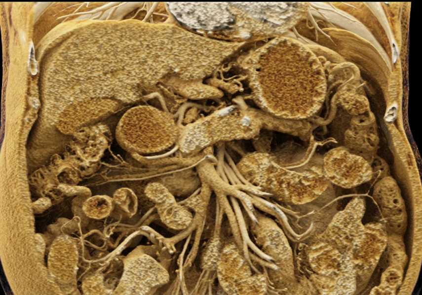 Carcinoma Body of the Pancreas - CTisus CT Scan