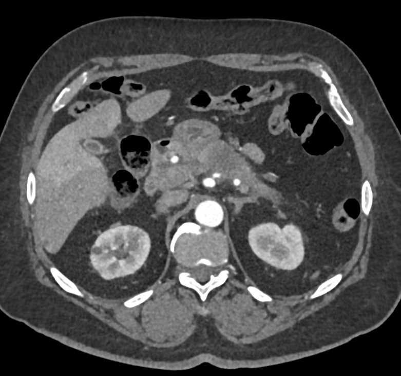 Carcinoma Body of the Pancreas - CTisus CT Scan