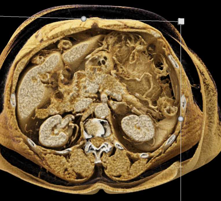 Adenocarcinoma Body of Pancreas with Cinematic Rendering - CTisus CT Scan