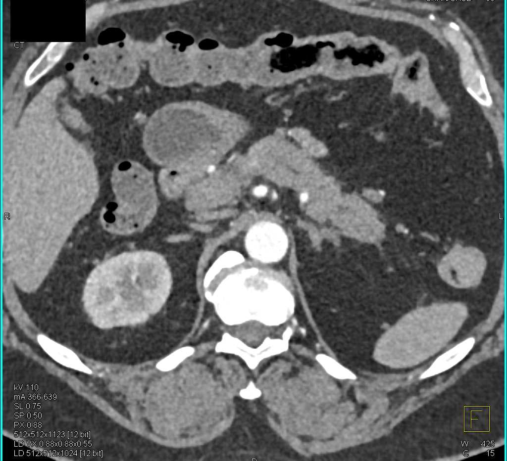 Carcinoma Body of the Pancreas - CTisus CT Scan