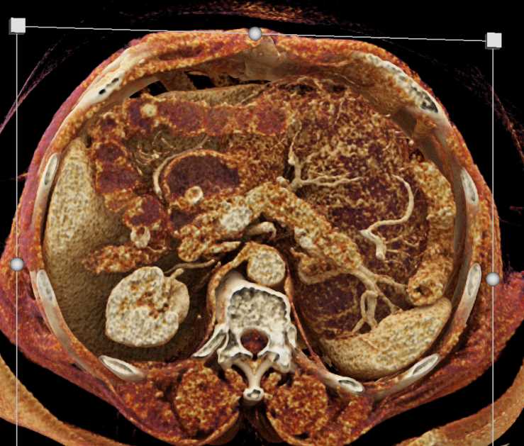 Carcinoma Body of the Pancreas - CTisus CT Scan