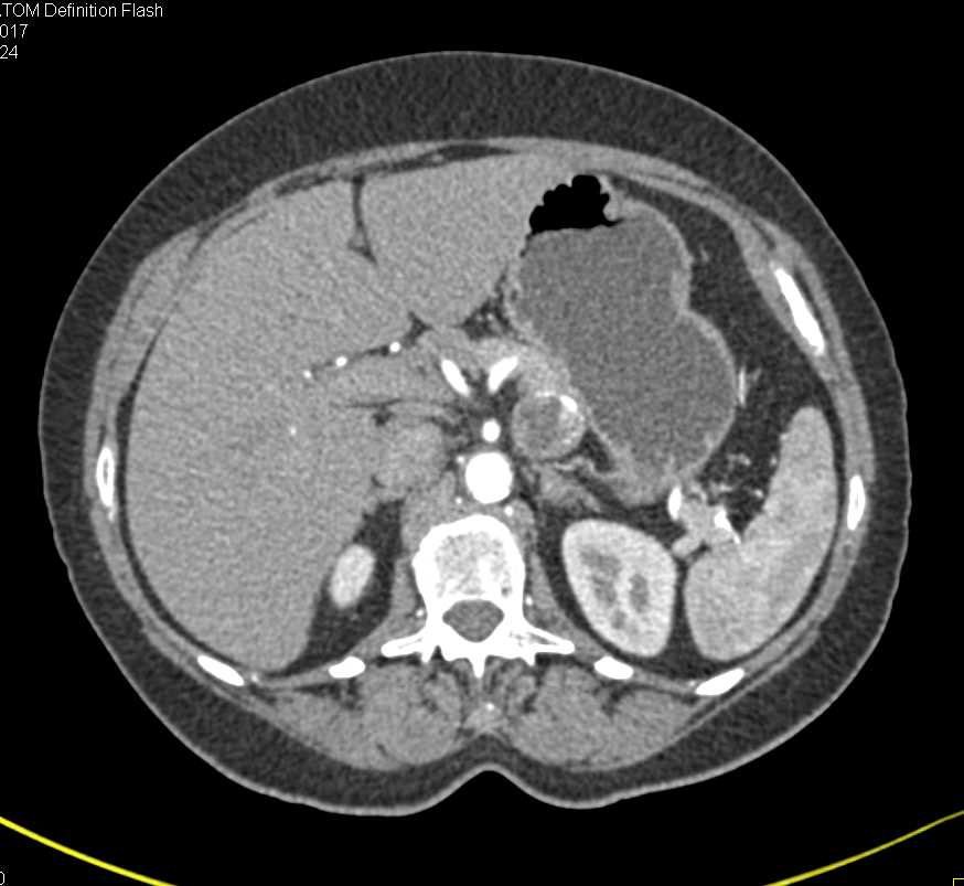 Pancreatic Neuroendocrine Tumor (PNET) of the Pancreas - CTisus CT Scan