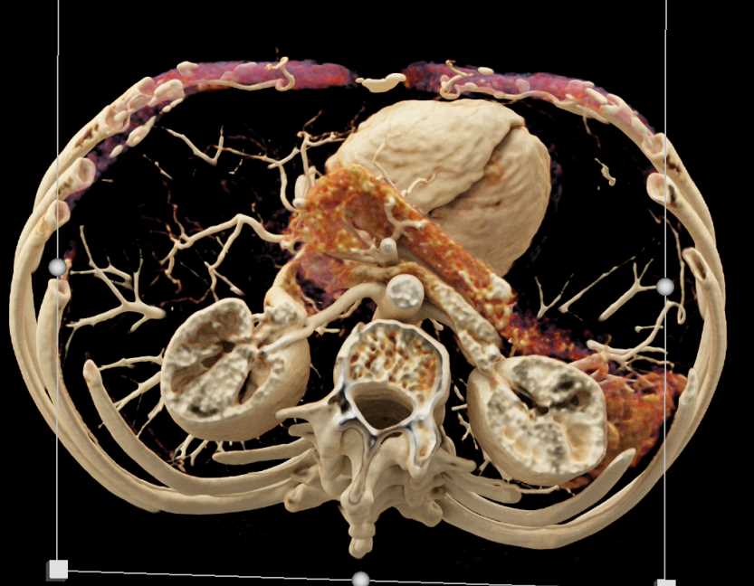 1cm Neuroendocrine Tumor in the Pancreas - CTisus CT Scan