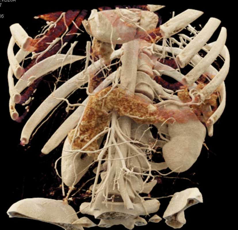 1cm Neuroendocrine Tumor in the Pancreas - CTisus CT Scan