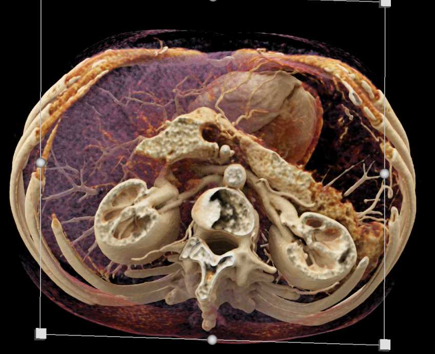 Carcinoma of the tail of the Pancreas - CTisus CT Scan