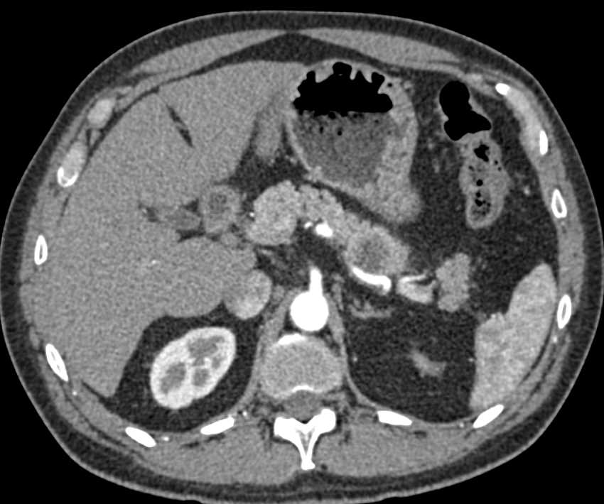 MCN (Mucinous Cystic Neoplasm) Tail of Pancreas - CTisus CT Scan