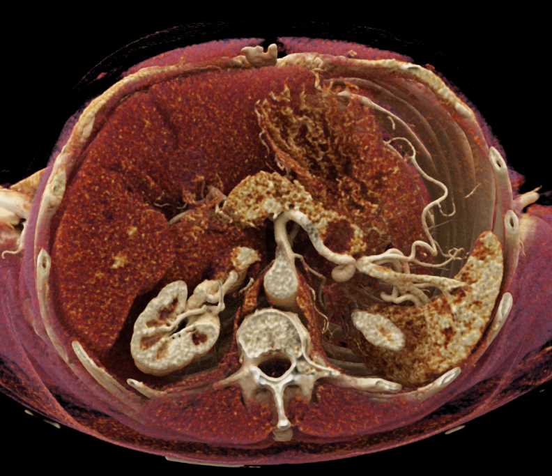 MCN (Mucinous Cystic Neoplasm) Tail of Pancreas - CTisus CT Scan