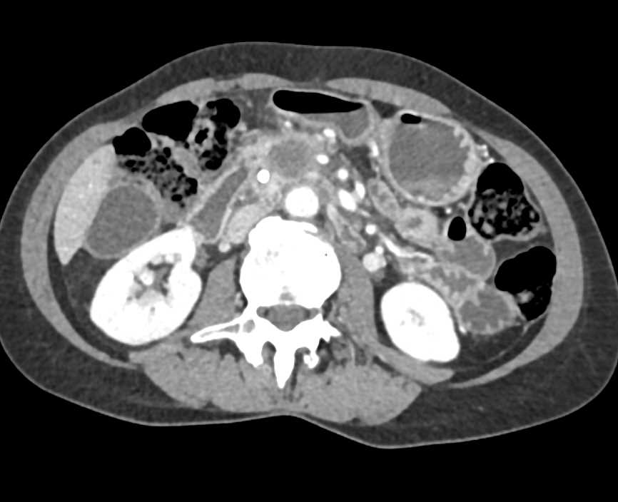 Pancreas Adenocarcinoma - CTisus CT Scan