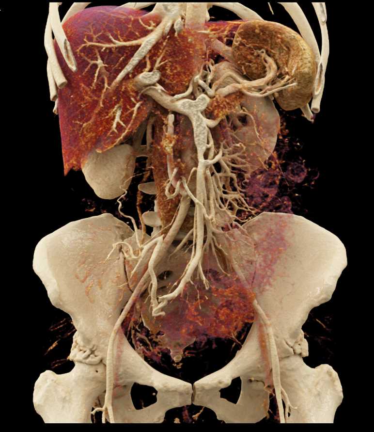 Pancreas Adenocarcinoma with Superior Mesenteric Vein (SMV) Encasement with Cinematic Rendering - CTisus CT Scan