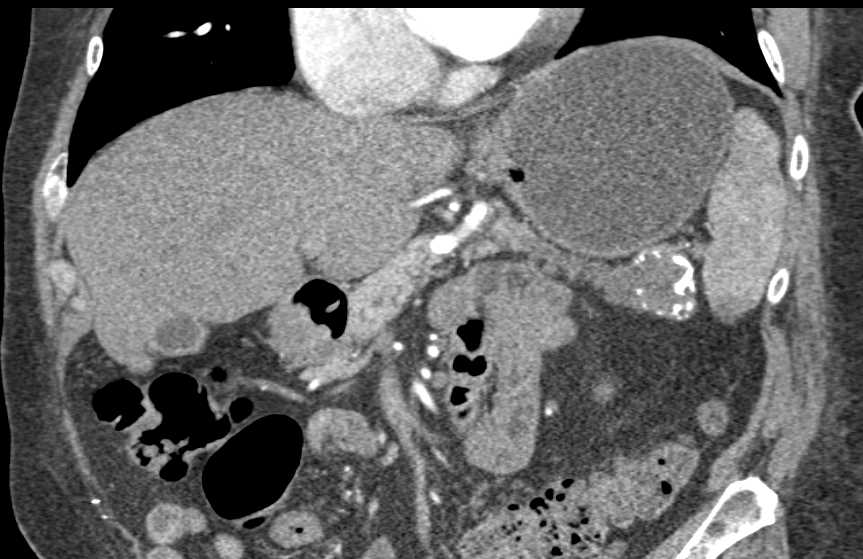 Neuroendocrine Tumor Tail of Pancreas - CTisus CT Scan