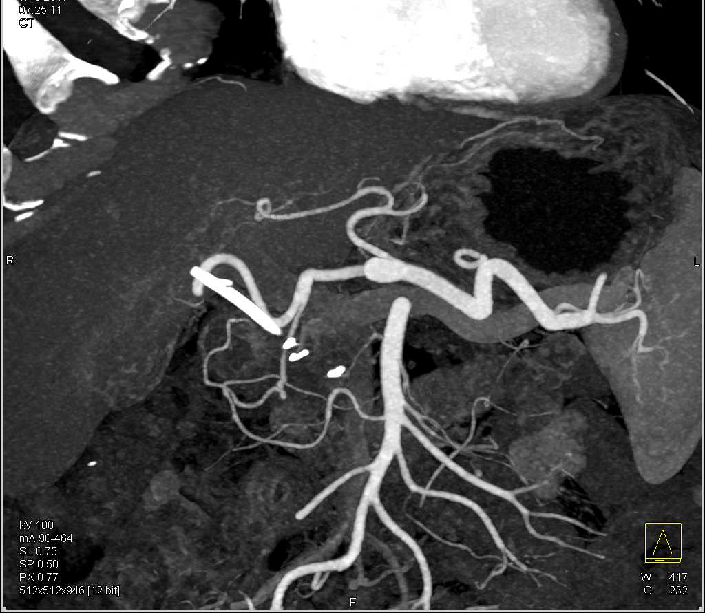 Adenocarcinoma Head of Pancreas - CTisus CT Scan