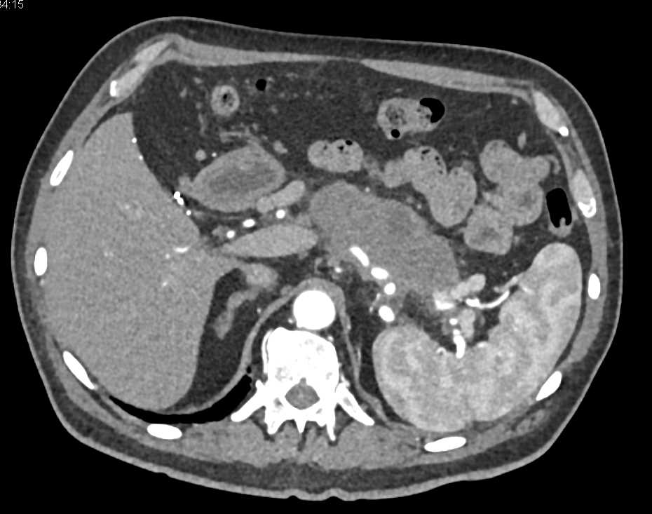 Adenocarcinoma Tail of Pancreas with Vascular Encasement - CTisus CT Scan