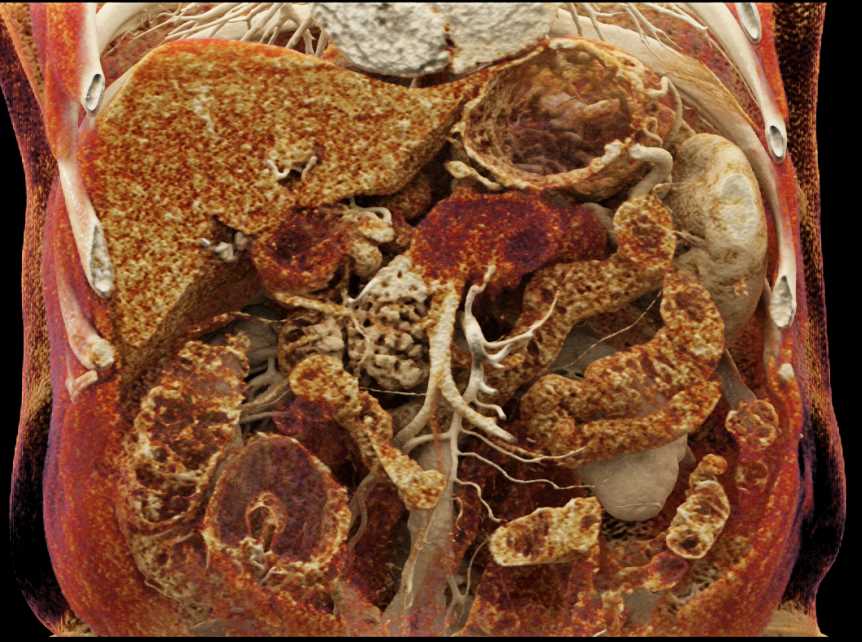 Adenocarcinoma Tail of Pancreas with Vascular Encasement - CTisus CT Scan