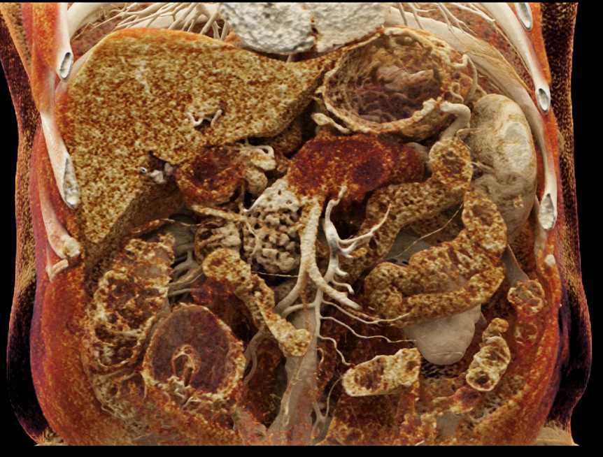 Adenocarcinoma Tail of Pancreas with Vascular Encasement - CTisus CT Scan