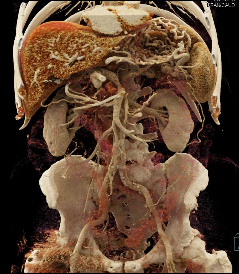 Adenocarcinoma Tail of Pancreas with Vascular Encasement Including Portal Vein - CTisus CT Scan