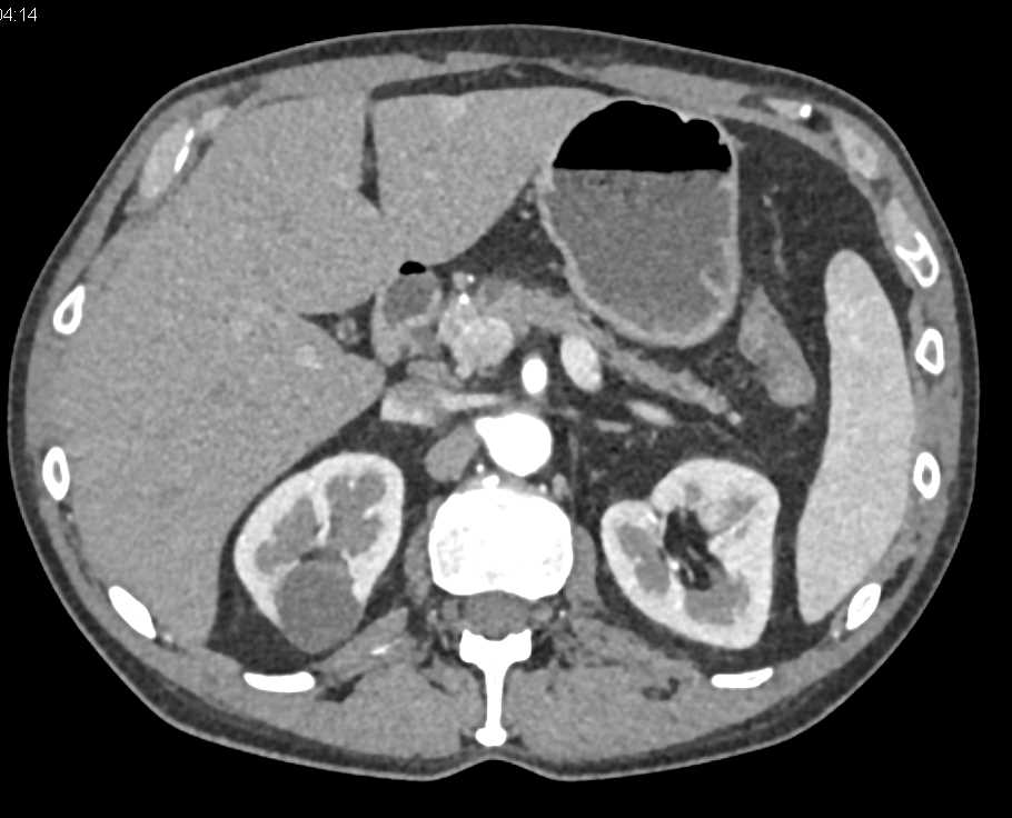 Subtle Carcinoma Body of Pancreas - CTisus CT Scan