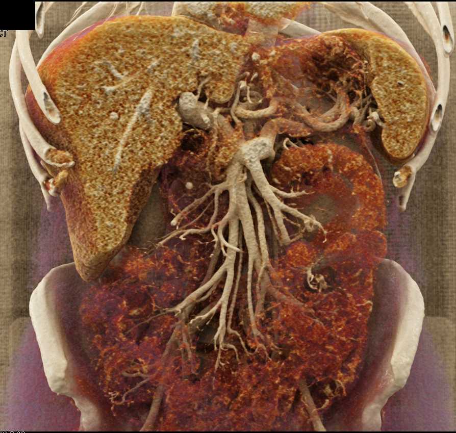 Subtle Carcinoma Body of Pancreas - CTisus CT Scan