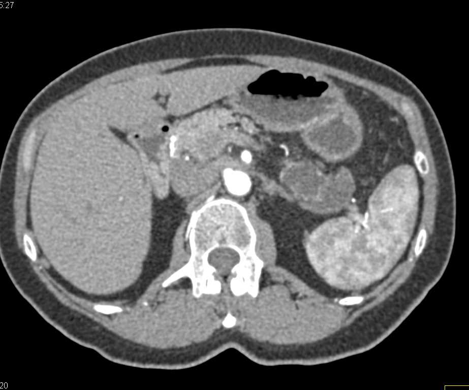 Intraductal Papillary Mucinous Neoplasm (IPMN) with High Grade Dysplasia - CTisus CT Scan