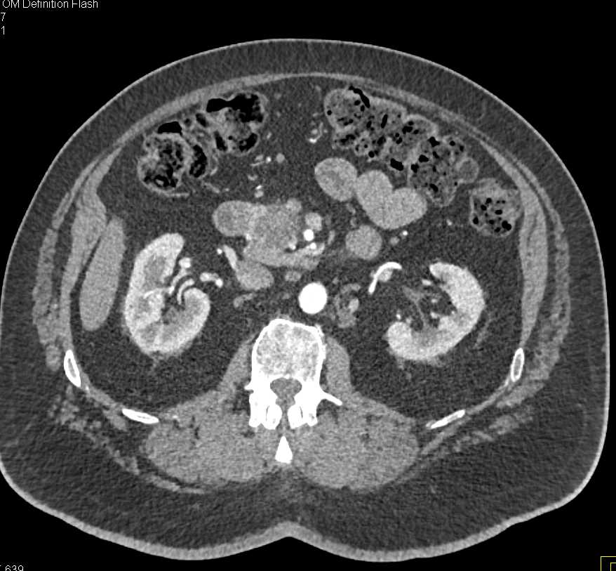 Intraductal Papillary Mucinous Neoplasm (IPMN) with High Grade Dysplasia - CTisus CT Scan