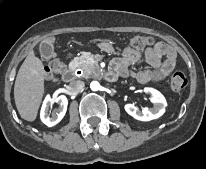 Carcinoma Head of Pancreas - CTisus CT Scan