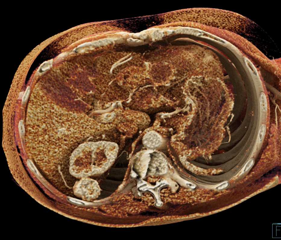 Metastatic Renal Cell Carcinoma to the Pancreas and Perirenal Space - CTisus CT Scan