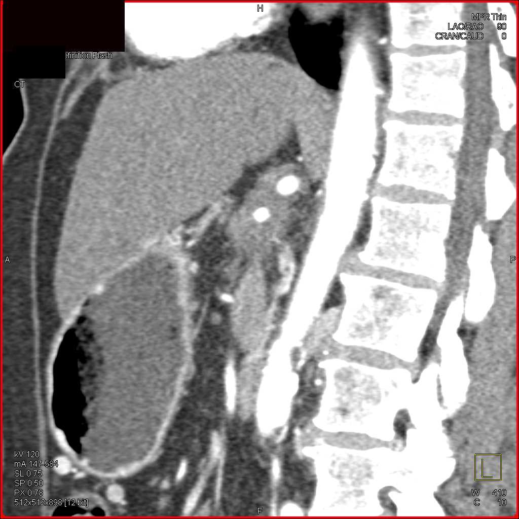 Pancreatic Adenocarcinoma Encases the Celiac and Superior Mesenteric Artery (SMA) and Occludes the Splenic Vein - CTisus CT Scan