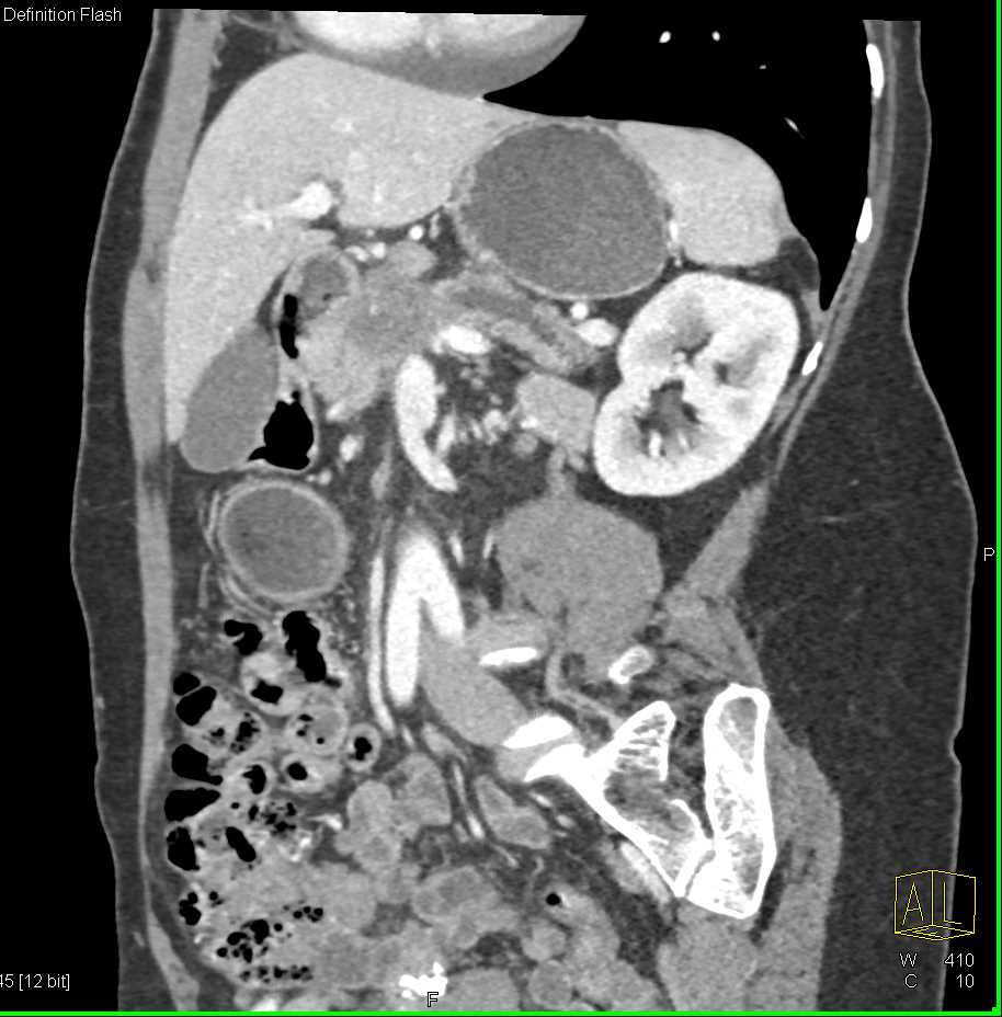 Pancreas Adenocarcinoma - CTisus CT Scan