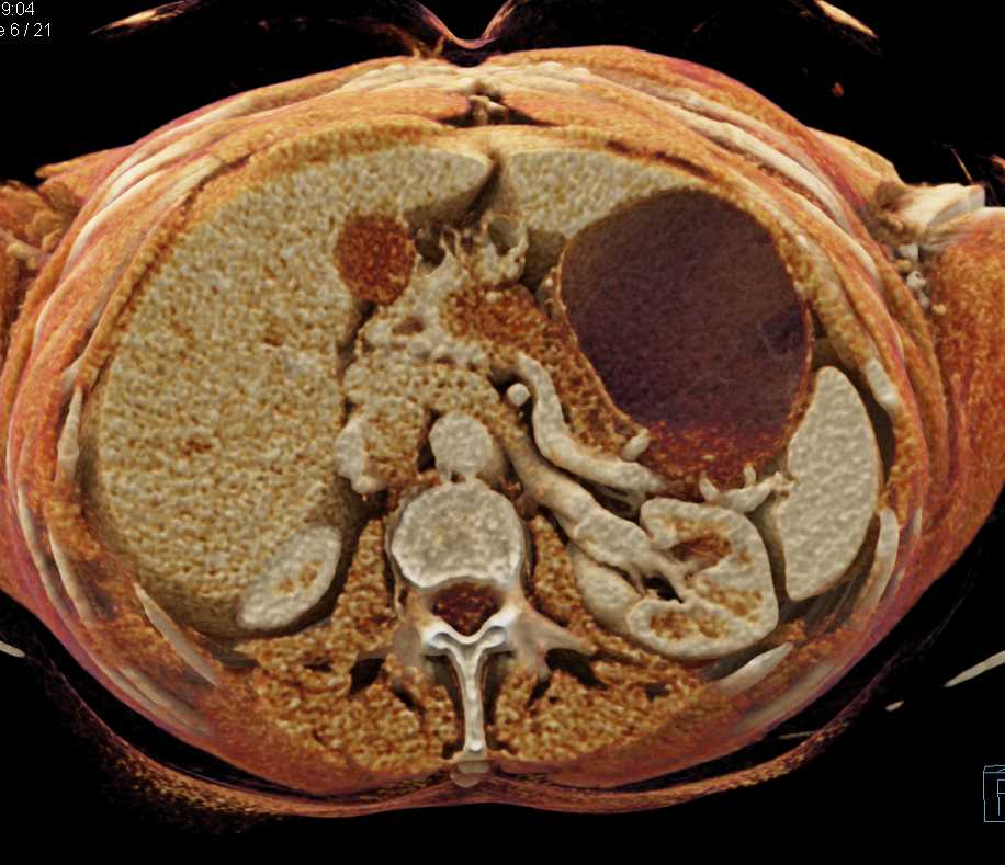 Pancreas Adenocarcinoma with Cinematic Rendering - CTisus CT Scan