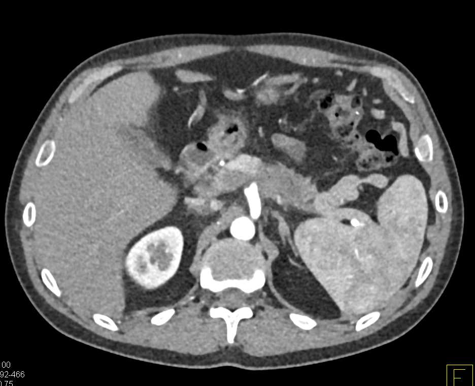 Pancreatic Cancer with Vascular Encasement - CTisus CT Scan