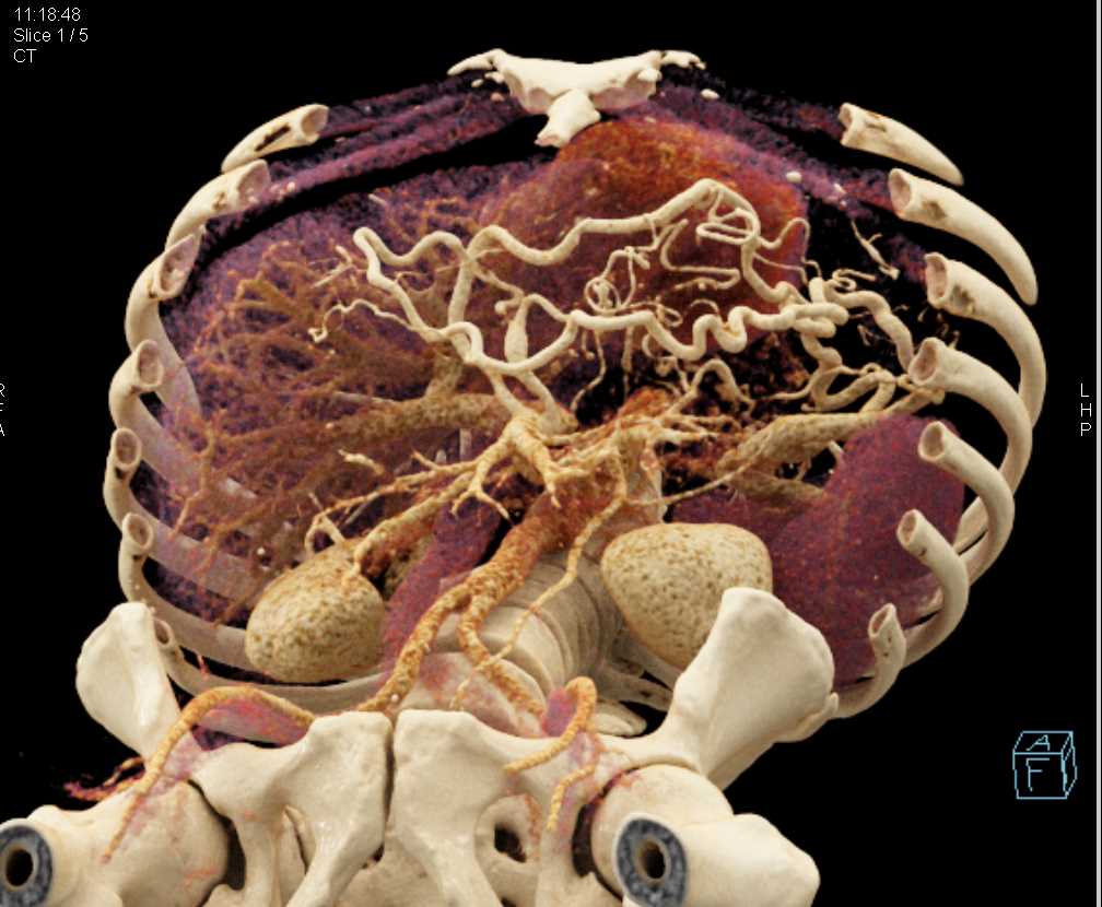 Pancreatic Cancer Body of Pancreas with Vascular Collaterals - CTisus CT Scan