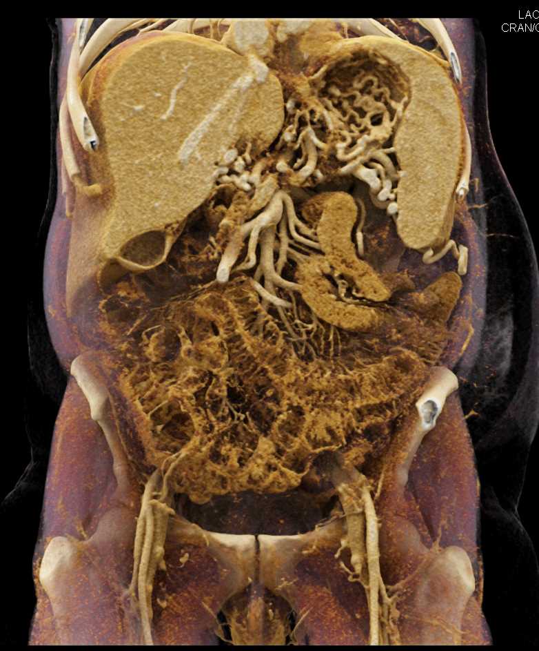 Vascular Collaterals due to Portal Vein Involvement - CTisus CT Scan