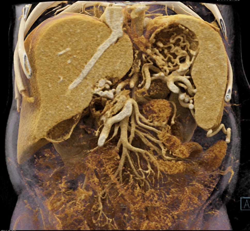 Vascular Collaterals due to Portal Vein Involvement - CTisus CT Scan