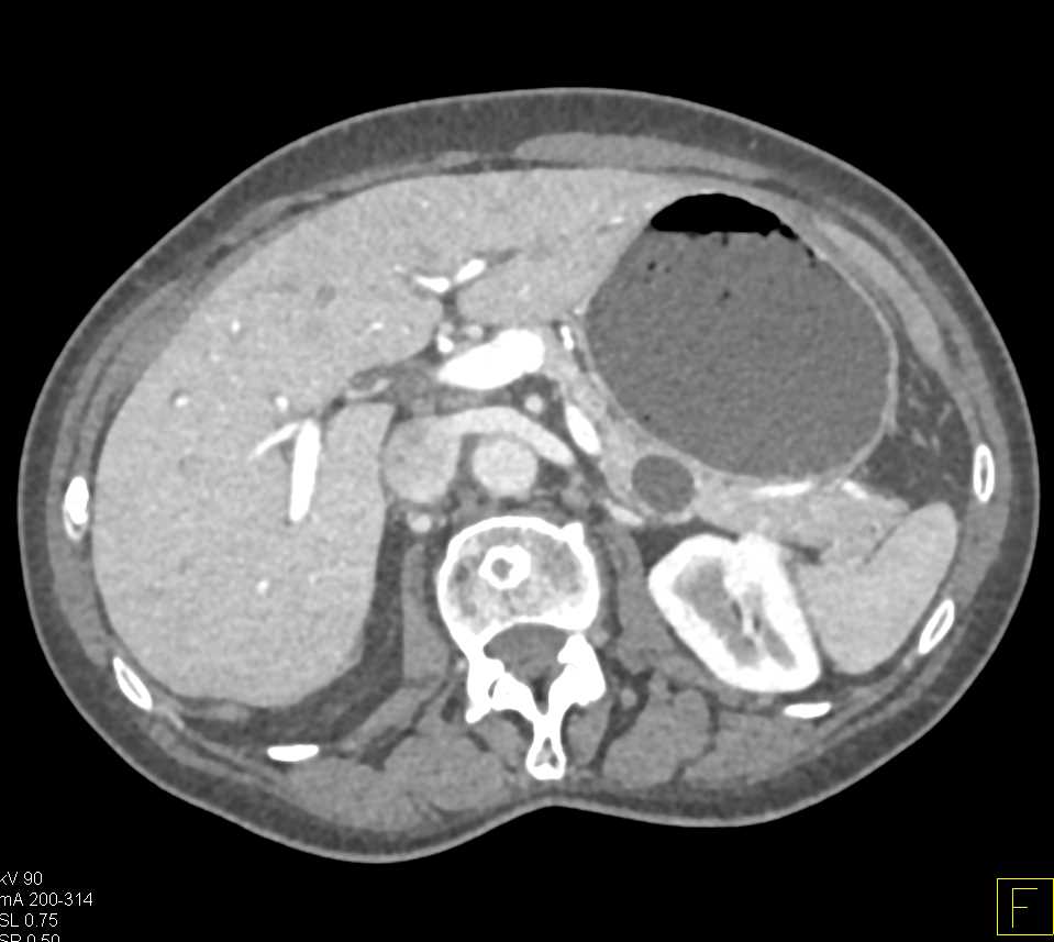 Intraductal Papillary Mucinous Neoplasm (IPMN) Tail of Pancreas - CTisus CT Scan