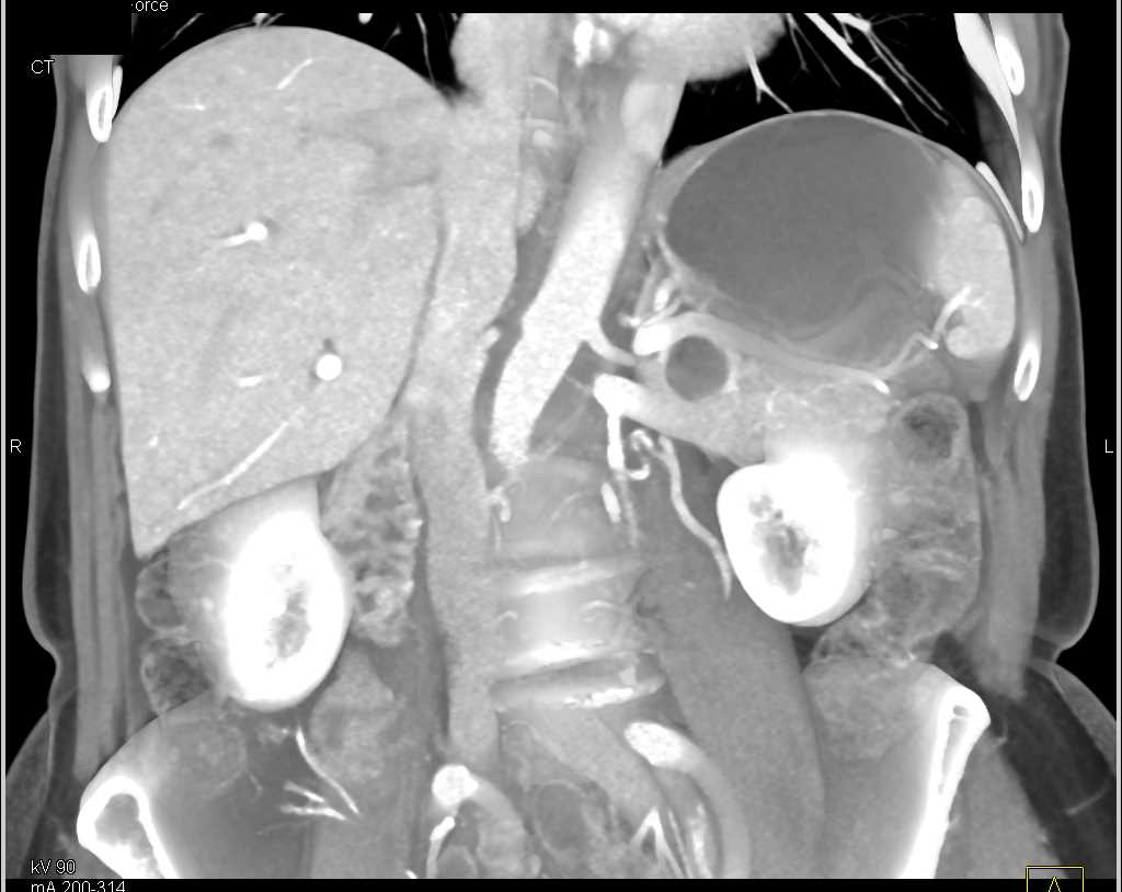 IPMN Tail of Pancreas - CTisus CT Scan