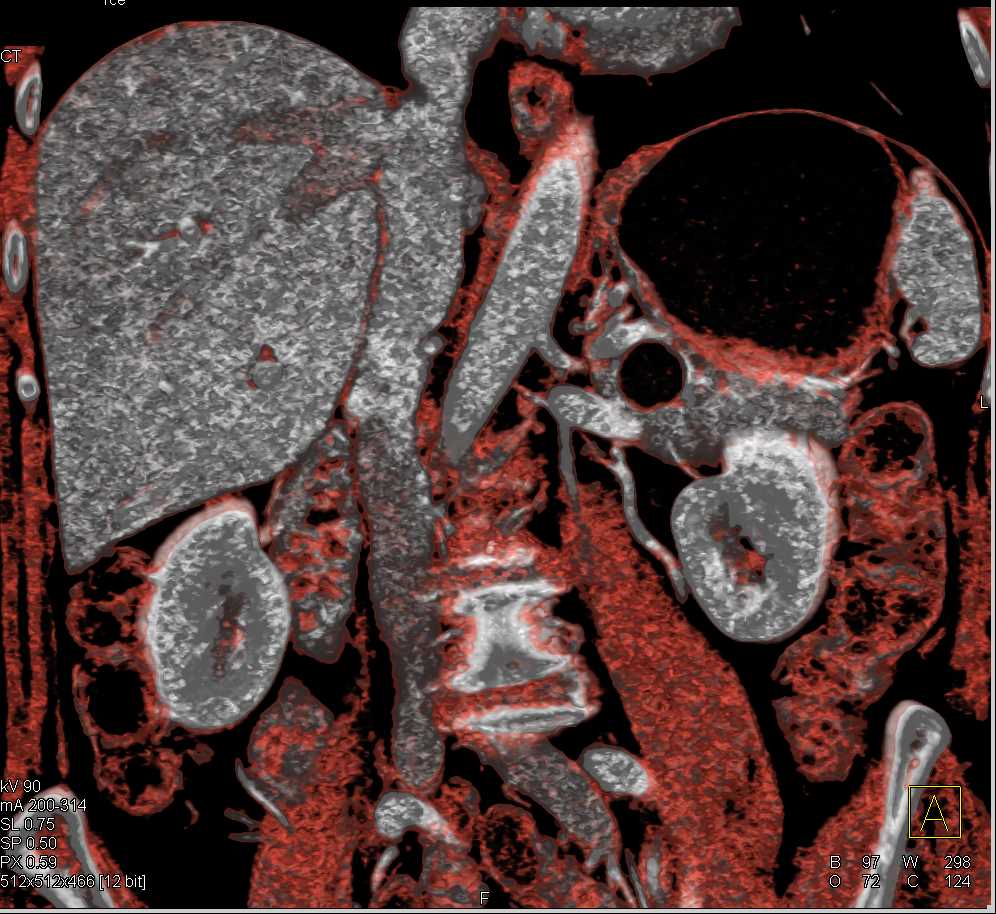 Intraductal Papillary Mucinous Neoplasm (IPMN) Tail of Pancreas - CTisus CT Scan