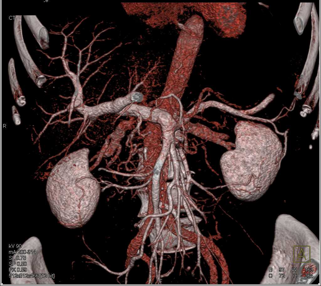 IPMN Tail of Pancreas - CTisus CT Scan