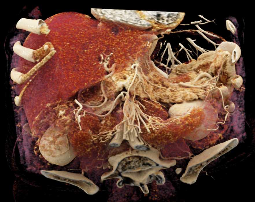 Vascular Mapping of the Pancreas and Liver - CTisus CT Scan