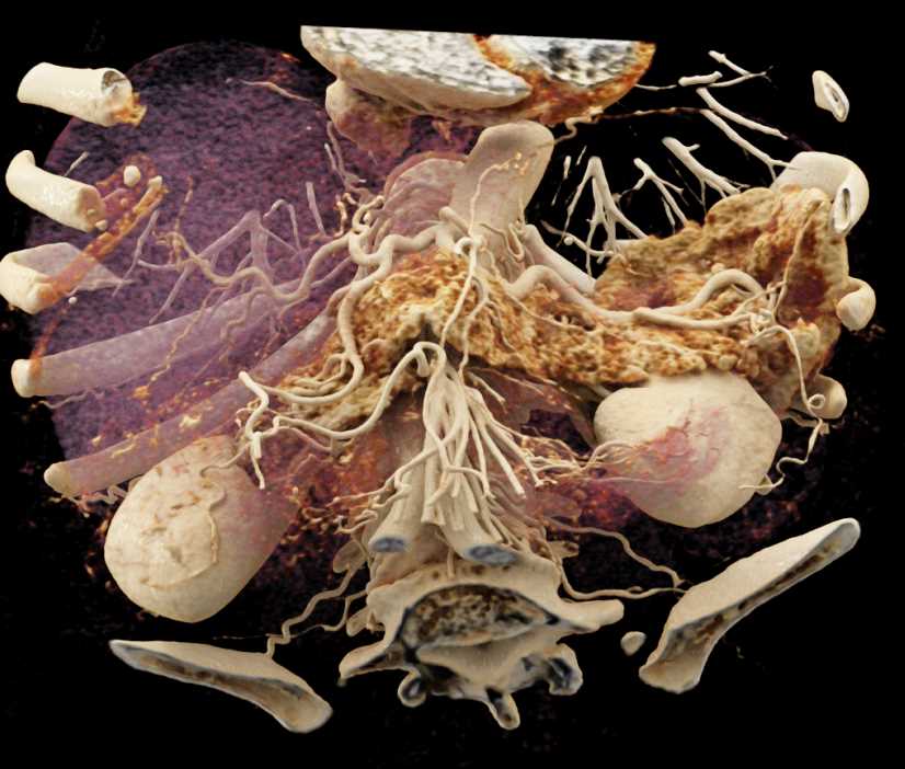 Vascular Mapping of the Pancreas and Liver - CTisus CT Scan