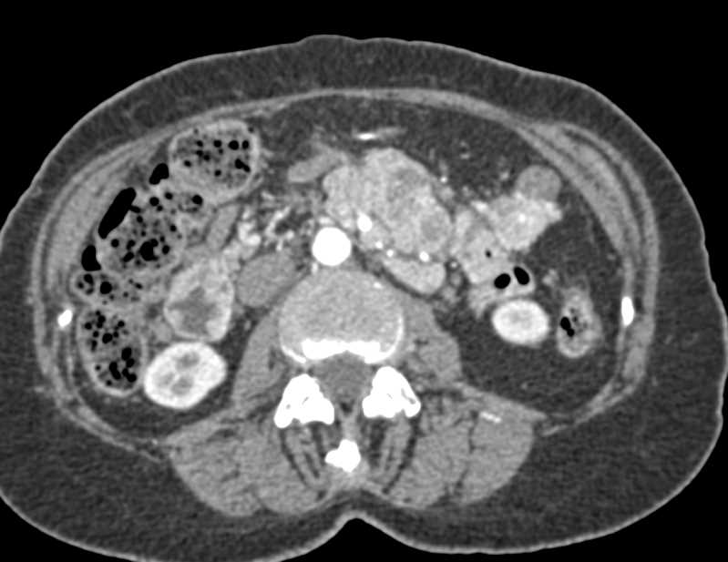 Metastatic Neuroendocrine Tumor - CTisus CT Scan