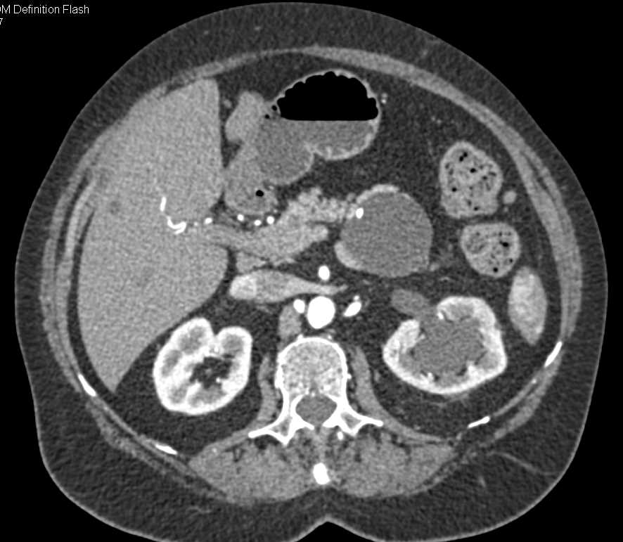 MCN (Mucinous Cystic Neoplasm) Tail of Pancreas - CTisus CT Scan