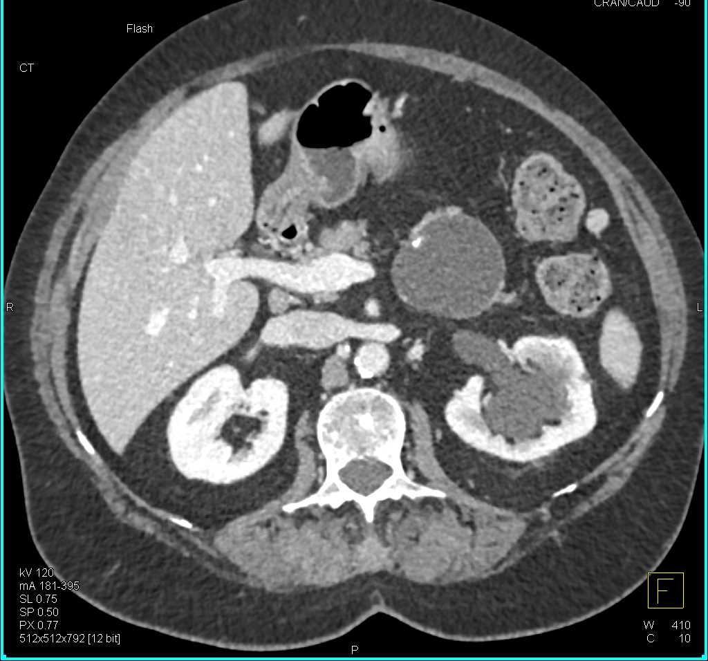 MCN (Mucinous Cystic Neoplasm) Tail of Pancreas - CTisus CT Scan