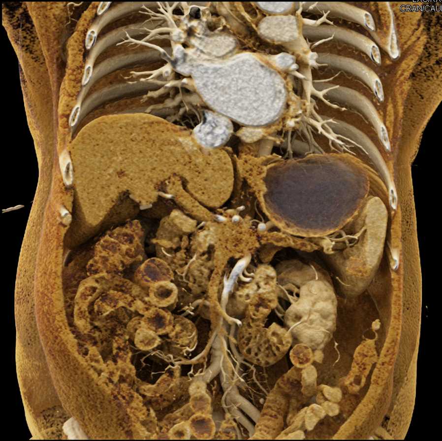 Collateral Pathways due to Invasive Pancreatic Adenocarcinoma Best Seen by PV/SMV - CTisus CT Scan