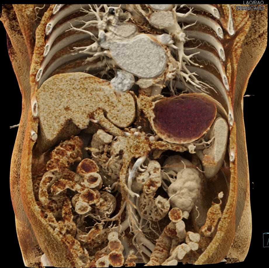 Collateral Pathways due to Invasive Pancreatic Adenocarcinoma Best Seen by PV/SMV - CTisus CT Scan
